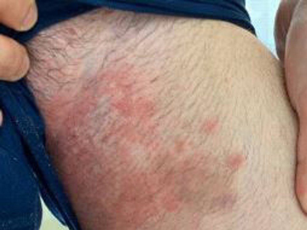 Európu trápi superpleseň, ktorá odoláva liečbe : Pozor na tieto príznaky!