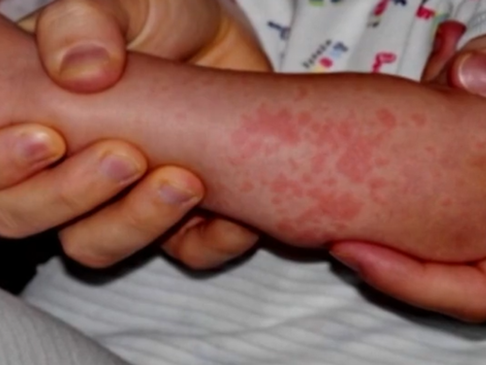 V Chorvátsku vyčíňa nebezpečná infekcia. Ohrození sú dospelí aj deti