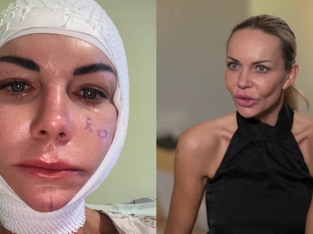 ŠOK po facelifte Moniky Nemčokovej: Ochabla jej časť tváre! TAKTO vyzerá dnes