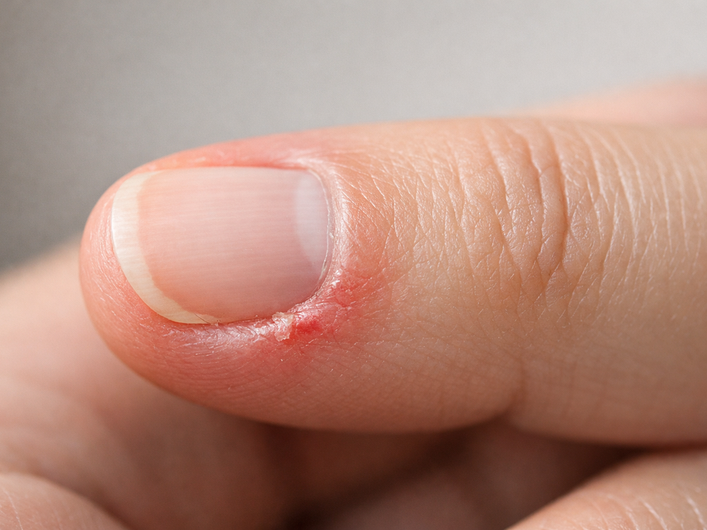 Zádery na prstoch nie sú len kozmetický problém: Prečo vznikajú a ako sa ich zbaviť?