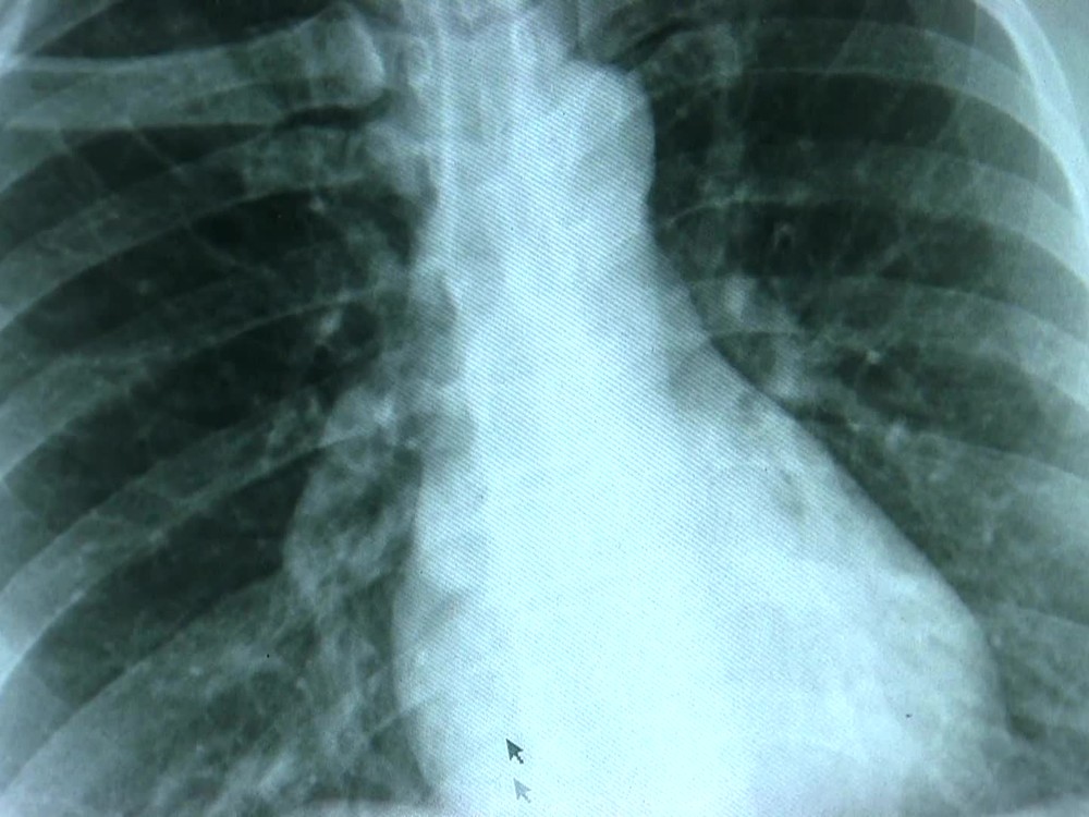 NENÁPADNÝ ZABIJAK:  Rakovinu pľúc ľudia často považujú za pretrvávajúcu infekciu