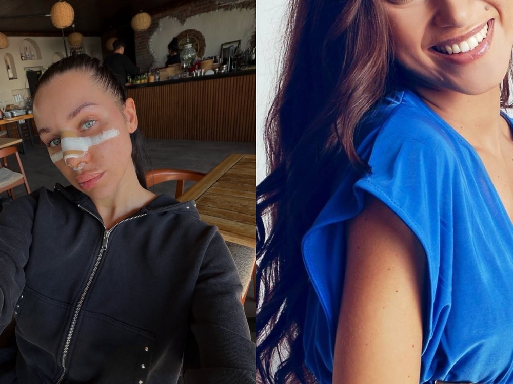 Bianka Rumanová kedysi vs. dnes: Zmenila jej plastika nosa celú tvár? FOTO porovnanie