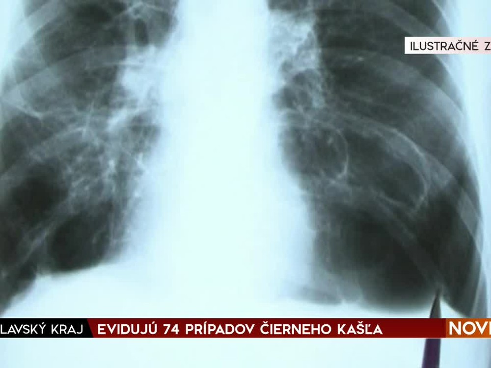 Keď rastie nádor pľúc, objavuje sa okrem kašľa aj iných 9 nečakaných príznakov. Onkologička ich popísala