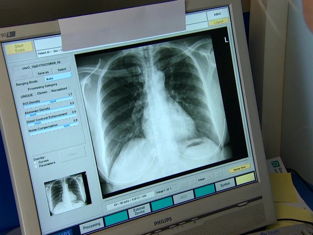 7 príznakov pľúcnej embólie: Čo vás môže varovať?