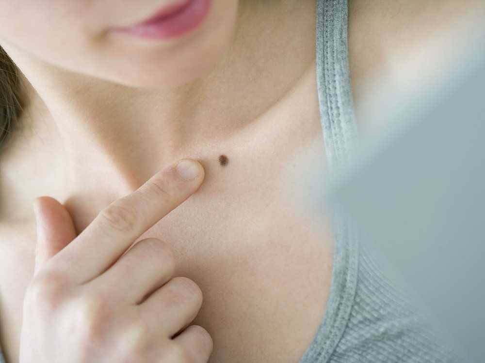 Dermatológ: Nechajte si pred letom skontrolovať znamienka, má to význam