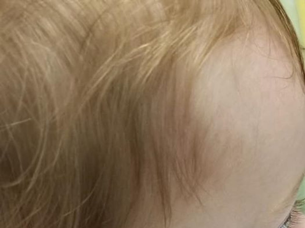 Odborník na popáleniny: Nikdy nevarte s dieťaťom na rukách