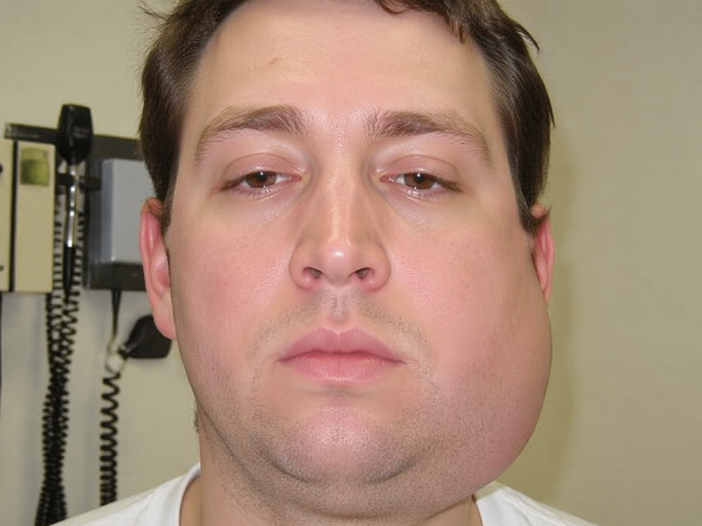 Postrach chlapcov a mladých mužov: Čo je to mumps a ako sa pred ním chrániť?