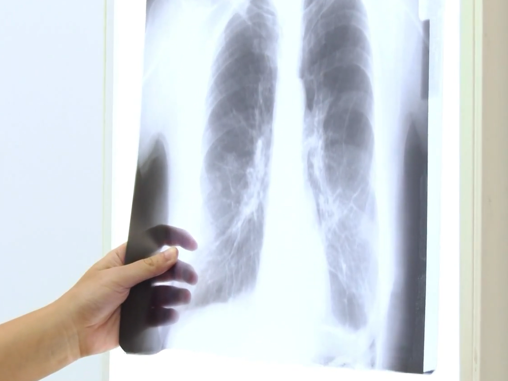 Pľúcna embolía: Zákerný stav, ktorý je náročné zistiť