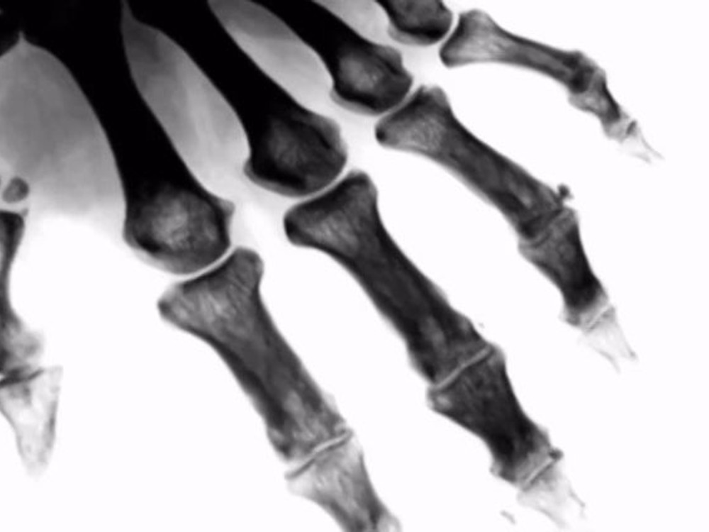 Choroba kráľov:  ZÁCHVAT DNY vás môže zastihnúť z ničoho nič