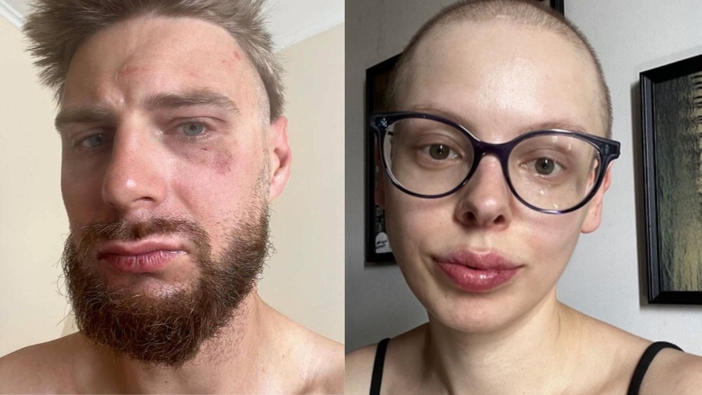 Napadnutý Jakub a jeho partnerka