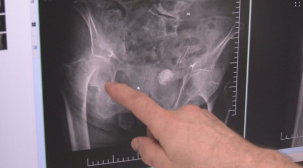 105-rocna pacientka vymena klbu (6)