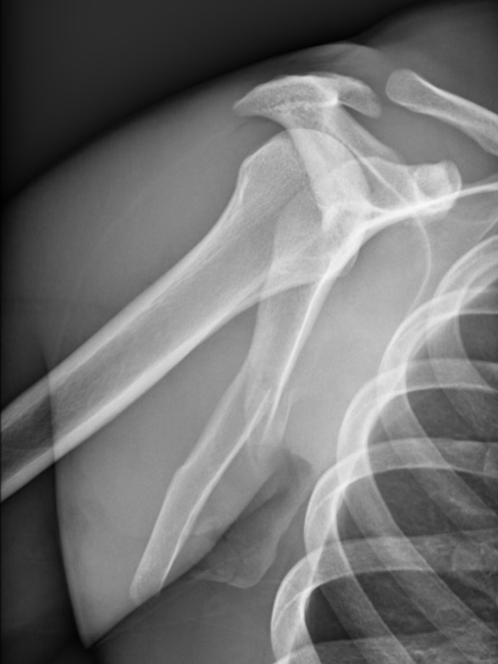 Close call and nasty crash a few weeks ago.A few injuries and fractures, but I’m glad I slept in (3)