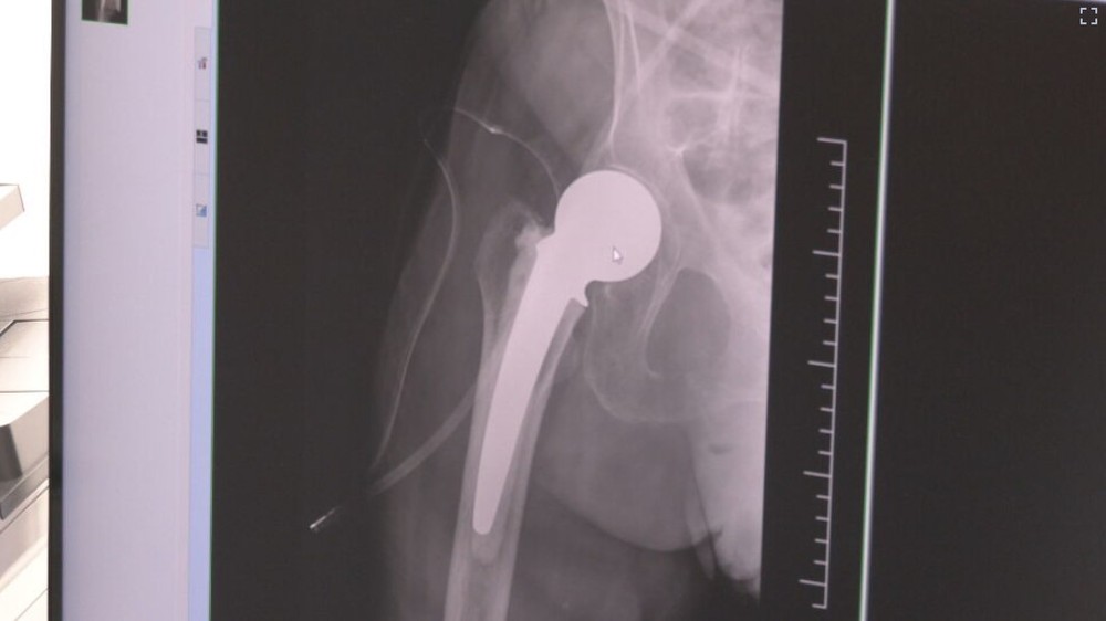 105-rocna pacientka vymena klbu (4)
