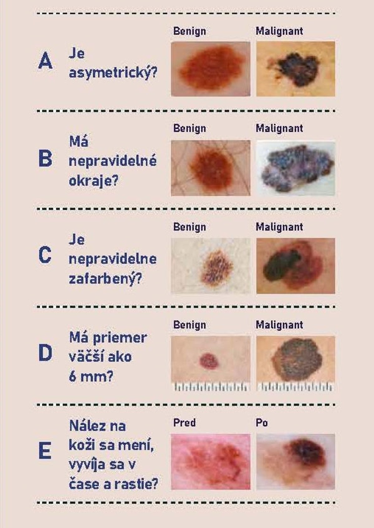Dajte si po lete prezrieť kožu. Melanóm postihuje aj ľudí, ktorí sa ...