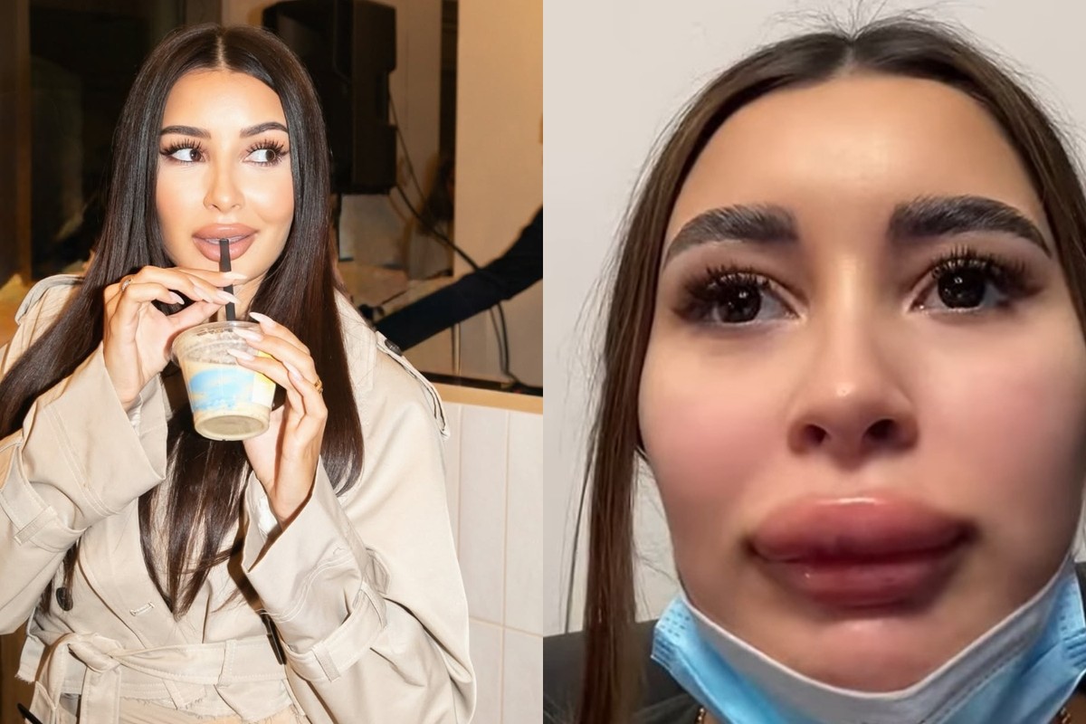 REALITA za dokonalými fotkami: Karolína zo šou #BTF ukázala TVÁR po estetickom zákroku!