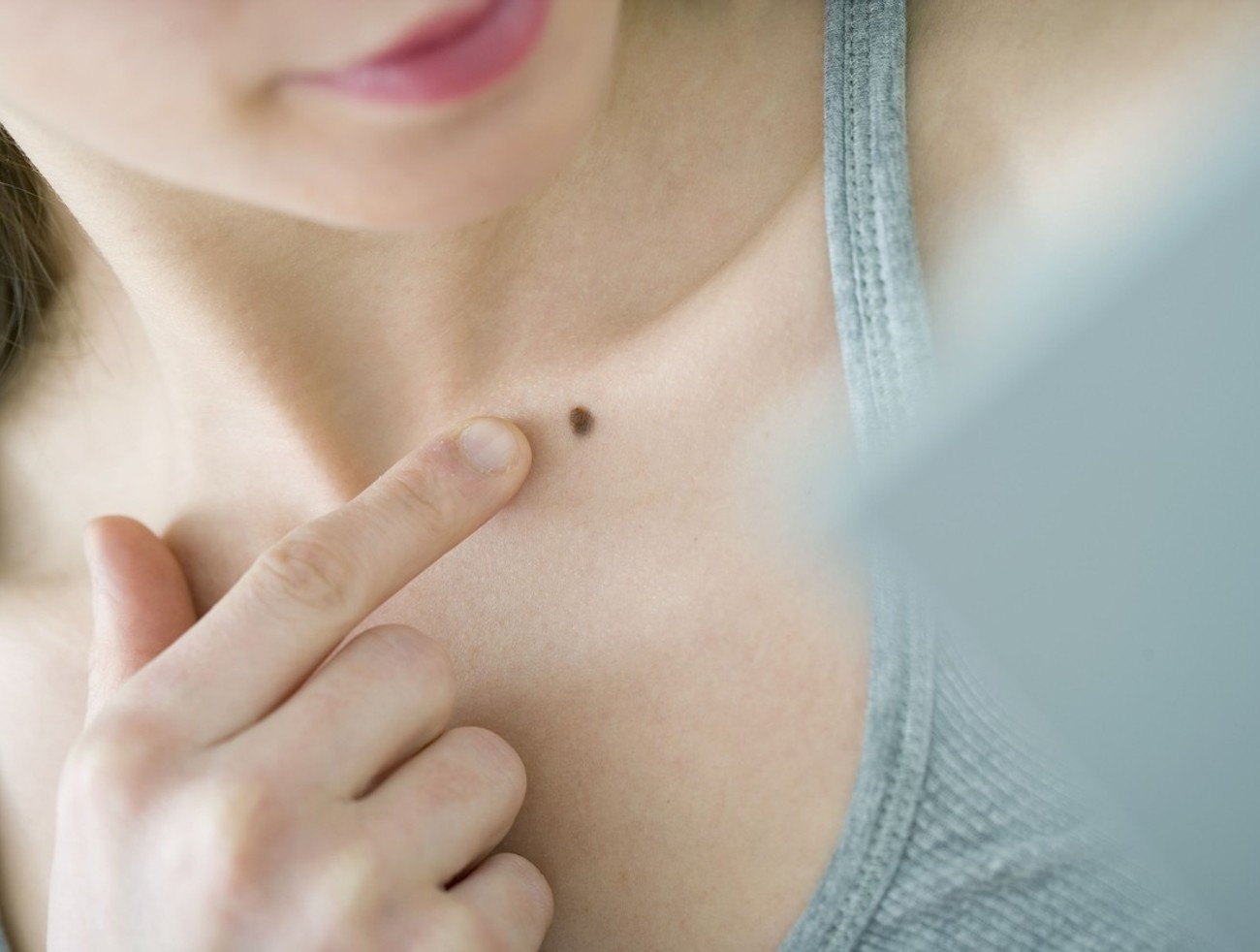 Dermatológ: Nechajte si pred letom skontrolovať znamienka, má to význam