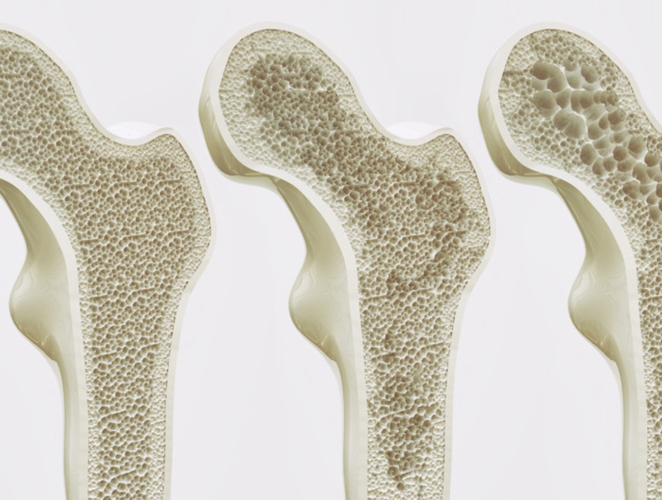 Osteoporóza je detská choroba,ktorá sa prejaví v dospelosti: Ako sa lieči?