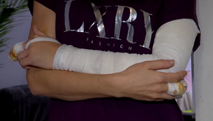 Na bežkyňu zaútočili tri agresívne psy. Hrýzli ju do ruky a stehna