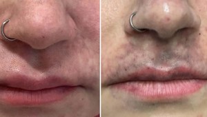 Hororový pohľad na Slovenku po omladzujúcom zákroku: Takmer prišla o tvár