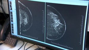 Väčšina žien nevyužíva vyšetrenie na odhalenie rakoviny prsníka. Skríning pritom odhalí nález skôr, ako si nahmatáte hrčku