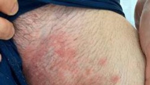 Európu trápi superpleseň, ktorá odoláva liečbe : Pozor na tieto príznaky!