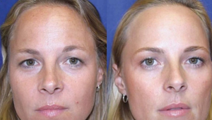 Jednej z dvojčiat pichali botox 20 rokov, druhá starla prirodzene: Ako to dopadlo?