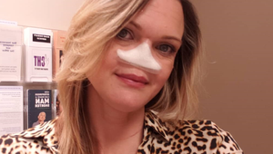 Tina prišla pre rakovinu o nos: Miesto neho tam má jednu veľkú dieru