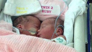 Siamským dvojičkám dávali malé šance na prežitie: Takto dnes vyzerajú 7-ročné sestry