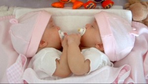 Siamské dvojičky sú vo vážnom stave