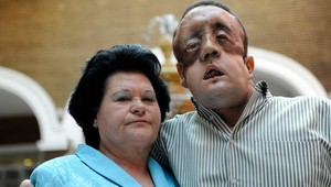 Pacient s transplantovanou tvárou sa ukázal svetu