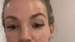 Žena ukázala, ako vyzerajú jej mega pery po rozpustení výplní: Fúha, toto by ste nečakali!