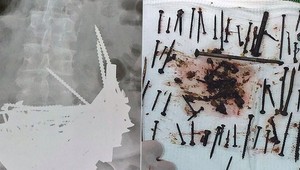 Lekári žasli. Žena jedla klince, bojovala tak s chudokrvnosťou