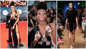 Trpí extrémnou stratou pigmentu, napriek tomu je topmodelkou