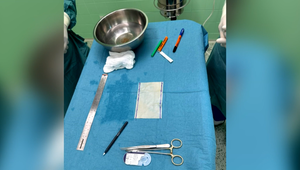 Unikátny zákrok: Na sále vlastnoručne ušili pacientovi protézu