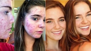 Ťažké akné je fuč: Zmena v jedálničku pomohla dvojičkám k zdravej pleti
