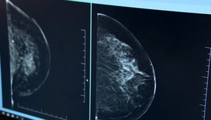 Covid-19 ovplyvnil aj onkologické skríningy. Tie vykonané odhalili desiatky prípadov