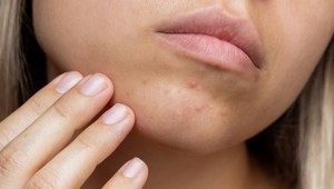 TikTok ovládol beauty TRIK na vyliečenie akné: Stačí zmiešať jednu surovinu s vodou