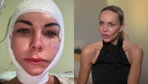 ŠOK po facelifte Moniky Nemčokovej: Ochabla jej časť tváre! TAKTO vyzerá dnes