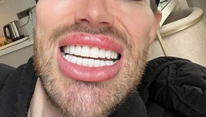 David túžil vyzerať ako Ken, za vylepšenia dal tisíce a teraz? Uff, TO muselo bolieť!