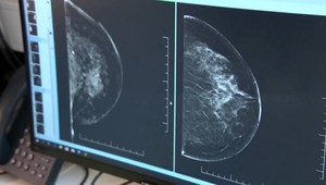 Nový výskum naznačuje, že rakovina prsníka sa šíri v noci