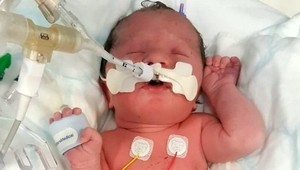 Ako dnes vyzerá dievčatko, ktoré sa narodilo s orgánmi mimo tela? Na TOTO čakala tri roky!