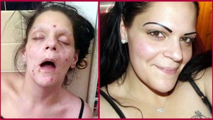 Bývalá narkomanka zverejnila svoju fotku na výstrahu pred drogami