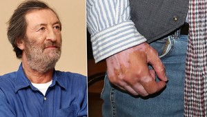 Trápenie Bolka Polívku: Ruky mu požiera choroba bielych škvŕn