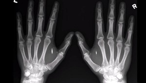 Firma implantuje svojim zamestnancom čipy. Zatiaľ dobrovoľne