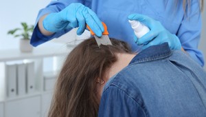 Zavšivavená žena musela vyhľadať odborníkov: Z toho, čo jej našli vo vlasoch, vám bude zle