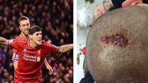 Hrdina Škrtel odhalil rozsah poranenia hlavy. To muselo bolieť