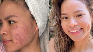 Kvôli problematickej pleti zažívala hotové muky: Takto sa zbavila akné aj bez liekov