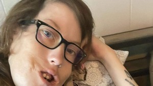 Ľudia jej písali, že si nezaslúži byť mamou: Žena so zdeformovanou tvárou neprajníkom vytrela zrak