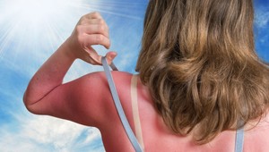 Ako zachrániť slnkom spálenú pokožku? Trik tejto matky je geniálny!