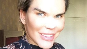 Pribral 18 kíl, jeho telo už neznesie ďalšiu liposukciu. Čaká ho zmenšenie žalúdka